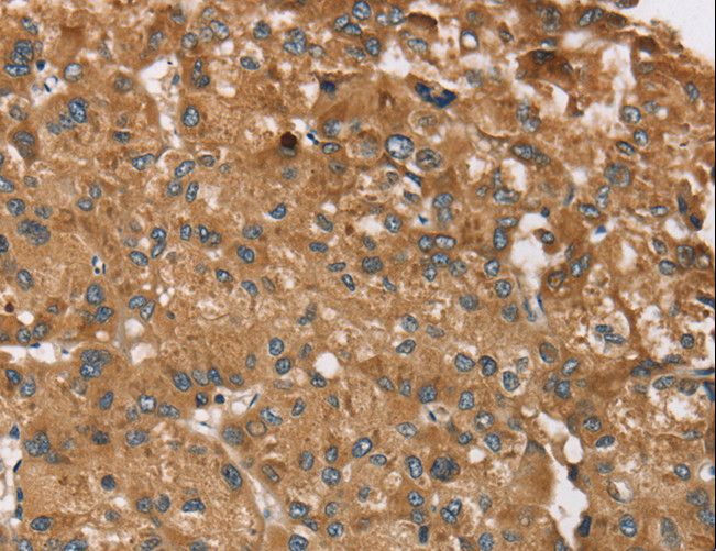 RPS6KA2 / RSK3 Antibody - Immunohistochemistry of paraffin-embedded Human colon cancer using RPS6KA2 Polyclonal Antibody at dilution of 1:40.