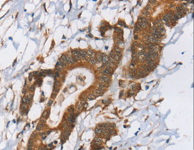 RPS6KA2 / RSK3 Antibody - Immunohistochemistry of paraffin-embedded Human colon cancer using RPS6KA2 Polyclonal Antibody at dilution of 1:40.