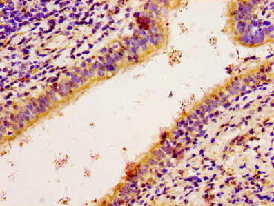 RPS6KA2 / RSK3 Antibody - Immunohistochemistry image of paraffin-embedded human lung cancer at a dilution of 1:100