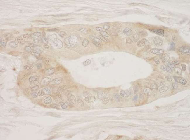 RPS6KA3 / RSK2 Antibody - Detection of Human RSK2 by Immunohistochemistry. Sample: FFPE section of human ovarian carcinoma. Antibody: Affinity purified rabbit anti-RSK2 used at a dilution of 1:250.