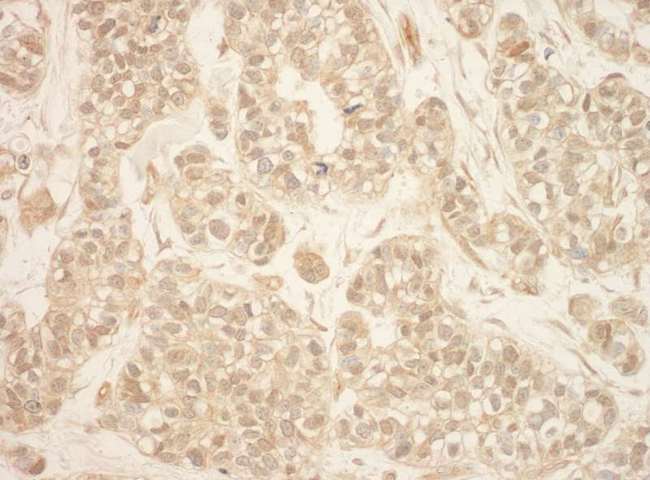 RPS6KA3 / RSK2 Antibody - Detection of Human RSK2 by Immunohistochemistry. Sample: FFPE section of human breast carcinoma. Antibody: Affinity purified rabbit anti-RSK2 used at a dilution of 1:1000 (1 ug/ml). Detection: DAB.
