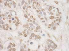 RPS6KA4 / MSK2 / RSK-B Antibody - Detection of Human MSK2 by Immunohistochemistry. Sample: FFPE section of human breast carcinoma. Antibody: Affinity purified rabbit anti-MSK2 used at a dilution of 1:200 (1 ug/mg).