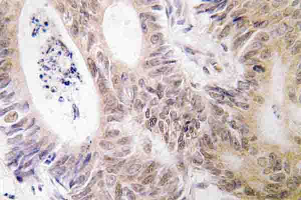 RPS6KA5 / MSK1 Antibody - IHC of MSK1 (D205) pAb in paraffin-embedded human colon carcinoma tissue.