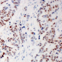 RPS6KA5 / MSK1 Antibody - Immunohistochemical analysis of MSK1 staining in human breast cancer formalin fixed paraffin embedded tissue section. The section was pre-treated using heat mediated antigen retrieval with sodium citrate buffer (pH 6.0). The section was then incubated with the antibody at room temperature and detected using an HRP conjugated compact polymer system. DAB was used as the chromogen. The section was then counterstained with hematoxylin and mounted with DPX.