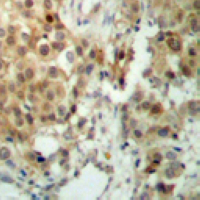 RPS6KA5 / MSK1 Antibody - Immunohistochemical analysis of MSK1 staining in human breast cancer formalin fixed paraffin embedded tissue section. The section was pre-treated using heat mediated antigen retrieval with sodium citrate buffer (pH 6.0). The section was then incubated with the antibody at room temperature and detected using an HRP conjugated compact polymer system. DAB was used as the chromogen. The section was then counterstained with hematoxylin and mounted with DPX.