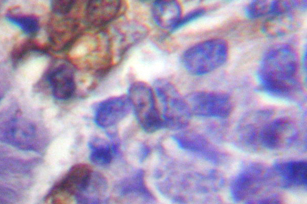RPS6KA5 / MSK1 Antibody - IHC of MSK1 (M355) pAb in paraffin-embedded human breast carcinoma tissue.