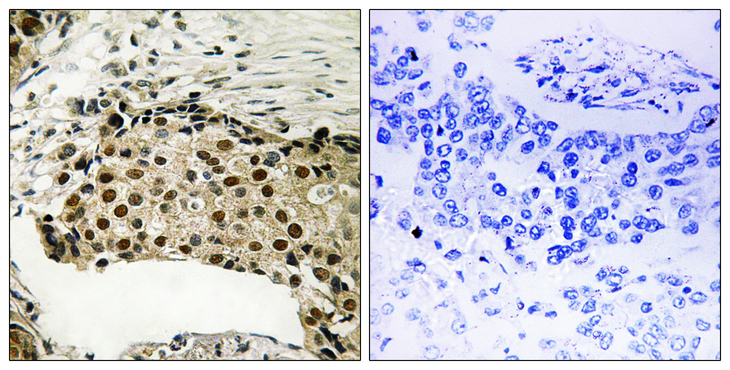 RPS6KA5 / MSK1 Antibody - Immunohistochemistry of paraffin-embedded human breast carcinoma tissue using MSK1 (Phospho-Ser212) antibody.