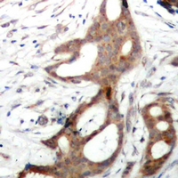 RPS6KA5 / MSK1 Antibody - Immunohistochemical analysis of MSK1 (pS212) staining in human prostate cancer formalin fixed paraffin embedded tissue section. The section was pre-treated using heat mediated antigen retrieval with sodium citrate buffer (pH 6.0). The section was then incubated with the antibody at room temperature and detected using an HRP polymer system. DAB was used as the chromogen. The section was then counterstained with hematoxylin and mounted with DPX.