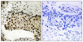 RPS6KA5 / MSK1 Antibody - P-peptide - + Immunohistochemistry analysis of paraffin-embedded human breast carcinoma tissue using MSK1 (Phospho-Ser212) antibody.
