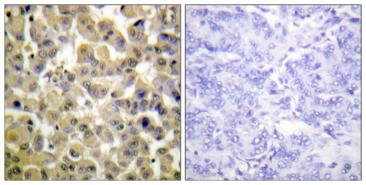 RPS6KA5 / MSK1 Antibody - Immunohistochemistry analysis of paraffin-embedded human breast carcinoma, using MSK1 (Phospho-Ser360) Antibody. The picture on the right is blocked with the phospho peptide.