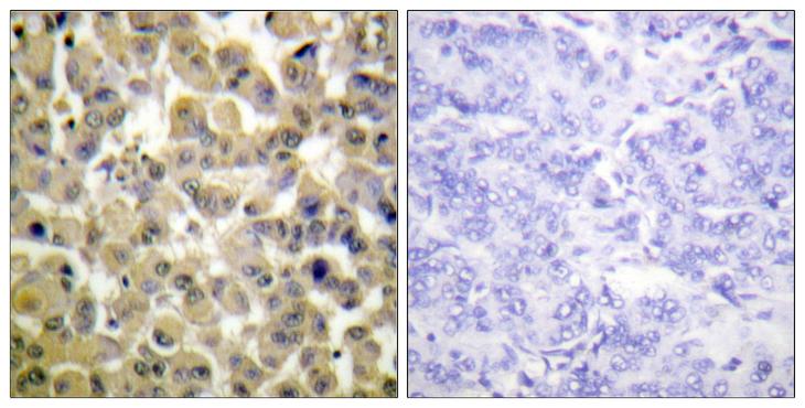 RPS6KA5 / MSK1 Antibody - P-peptide - + Immunohistochemistry analysis of paraffin-embedded human breast carcinoma tissue using MSK1 (Phospho-Ser360) antibody.