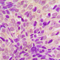 RPS6KA6 / RSK4 Antibody - Immunohistochemical analysis of RSK4 staining in human breast cancer formalin fixed paraffin embedded tissue section. The section was pre-treated using heat mediated antigen retrieval with sodium citrate buffer (pH 6.0). The section was then incubated with the antibody at room temperature and detected using an HRP-conjugated compact polymer system. DAB was used as the chromogen. The section was then counterstained with hematoxylin and mounted with DPX.