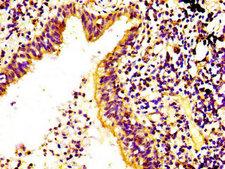RPS6KA6 / RSK4 Antibody - Immunohistochemistry image at a dilution of 1:400 and staining in paraffin-embedded human lung cancer performed on a Leica BondTM system. After dewaxing and hydration, antigen retrieval was mediated by high pressure in a citrate buffer (pH 6.0) . Section was blocked with 10% normal goat serum 30min at RT. Then primary antibody (1% BSA) was incubated at 4 °C overnight. The primary is detected by a biotinylated secondary antibody and visualized using an HRP conjugated SP system.