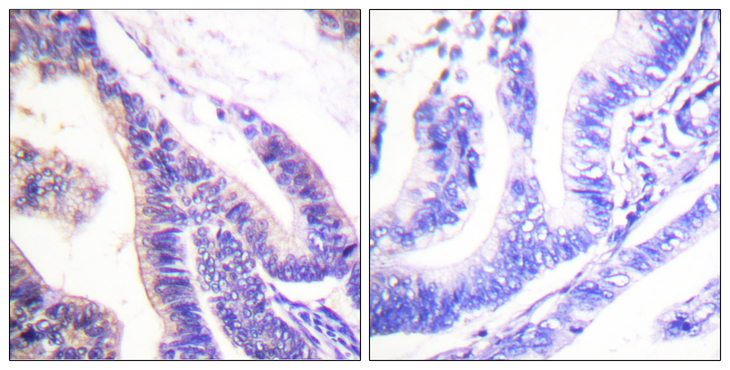 RPS6KB1 / P70S6K / S6K Antibody - Immunohistochemistry analysis of paraffin-embedded human colon carcinoma tissue, using p70 S6 Kinase Antibody. The picture on the right is blocked with the synthesized peptide.