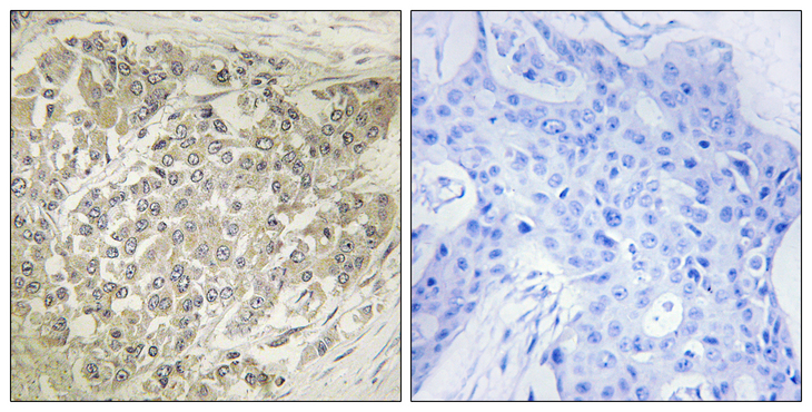 RPS6KB1 / P70S6K / S6K Antibody - Immunohistochemistry analysis of paraffin-embedded human breast carcinoma tissue, using p70 S6 Kinase Antibody. The picture on the right is blocked with the synthesized peptide.