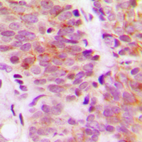 RPS6KB1 / P70S6K / S6K Antibody - Immunohistochemical analysis of S6K1 staining in human breast cancer formalin fixed paraffin embedded tissue section. The section was pre-treated using heat mediated antigen retrieval with sodium citrate buffer (pH 6.0). The section was then incubated with the antibody at room temperature and detected using an HRP conjugated compact polymer system. DAB was used as the chromogen. The section was then counterstained with hematoxylin and mounted with DPX.