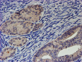 RPS6KB1 / P70S6K / S6K Antibody - IHC of paraffin-embedded Adenocarcinoma of Human endometrium tissue using anti-RPS6KB1 mouse monoclonal antibody. (Heat-induced epitope retrieval by 10mM citric buffer, pH6.0, 100C for 10min).