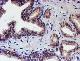 RPS6KB1 / P70S6K / S6K Antibody - IHC of paraffin-embedded Carcinoma of Human prostate tissue using anti-RPS6KB1 mouse monoclonal antibody. (Heat-induced epitope retrieval by 10mM citric buffer, pH6.0, 100C for 10min).