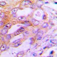 RPS6KB1 / P70S6K / S6K Antibody - Immunohistochemical analysis of S6K1 staining in human lung cancer formalin fixed paraffin embedded tissue section. The section was pre-treated using heat mediated antigen retrieval with sodium citrate buffer (pH 6.0). The section was then incubated with the antibody at room temperature and detected using an HRP-conjugated compact polymer system. DAB was used as the chromogen. The section was then counterstained with hematoxylin and mounted with DPX.