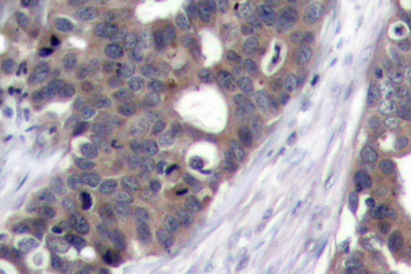 RPS6KB1 / P70S6K / S6K Antibody - IHC of p70 S6K (F428) pAb in paraffin-embedded human breast carcinoma tissue.