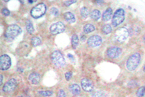 RPS6KB1 / P70S6K / S6K Antibody - IHC of p70 S6K (F438) pAb in paraffin-embedded human breast carcinoma tissue.