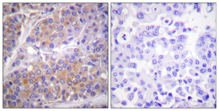 RPS6KB1 / P70S6K / S6K Antibody - Immunohistochemistry analysis of paraffin-embedded human breast carcinoma, using p70 S6 Kinase (Phospho-Ser371) Antibody. The picture on the right is blocked with the phospho peptide.
