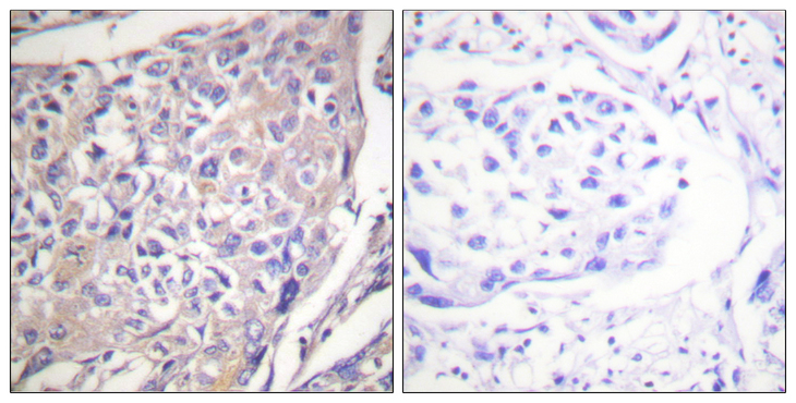 RPS6KB1 / P70S6K / S6K Antibody - Immunohistochemistry analysis of paraffin-embedded human breast carcinoma, using p70 S6 Kinase (Phospho-Ser418) Antibody. The picture on the right is blocked with the phospho peptide.