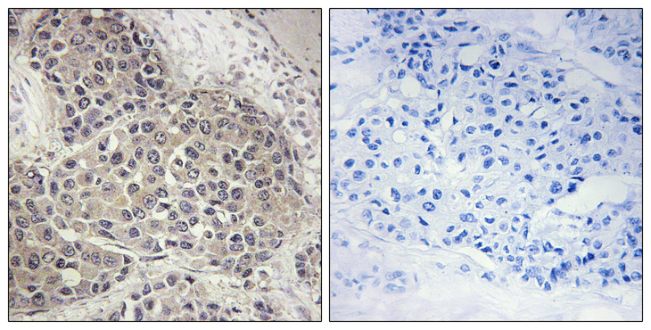 RPS6KB1 / P70S6K / S6K Antibody - Immunohistochemistry analysis of paraffin-embedded human breast carcinoma, using p70 S6 Kinase (Phospho-Ser424) Antibody. The picture on the right is blocked with the phospho peptide.