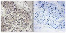 RPS6KB1 / P70S6K / S6K Antibody - Immunohistochemistry analysis of paraffin-embedded human breast carcinoma, using p70 S6 Kinase (Phospho-Ser424) Antibody. The picture on the right is blocked with the phospho peptide.