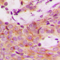 RPS6KB1 / P70S6K / S6K Antibody - Immunohistochemical analysis of S6K1 (pS447) staining in human breast cancer formalin fixed paraffin embedded tissue section. The section was pre-treated using heat mediated antigen retrieval with sodium citrate buffer (pH 6.0). The section was then incubated with the antibody at room temperature and detected using an HRP conjugated compact polymer system. DAB was used as the chromogen. The section was then counterstained with hematoxylin and mounted with DPX.