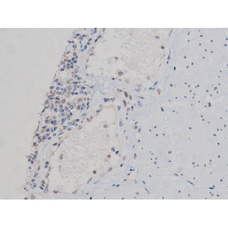 RPS6KB1 / P70S6K / S6K Antibody - 1:200 staining human esophagus tissue by IHC-P. The tissue was formaldehyde fixed and a heat mediated antigen retrieval step in citrate buffer was performed. The tissue was then blocked and incubated with the antibody for 1.5 hours at 22°C. An HRP conjugated goat anti-rabbit antibody was used as the secondary.