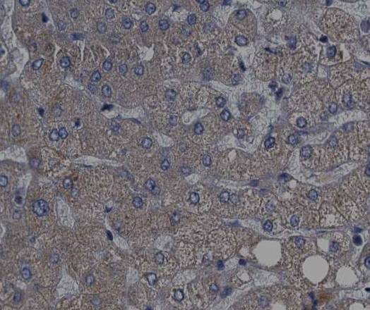 RPS6KB1 / P70S6K / S6K Antibody - 1:200 staining human liver carcinoma tissues by IHC-P. The tissue was formaldehyde fixed and a heat mediated antigen retrieval step in citrate buffer was performed. The tissue was then blocked and incubated with the antibody for 1.5 hours at 22°C. An HRP conjugated goat anti-rabbit antibody was used as the secondary.