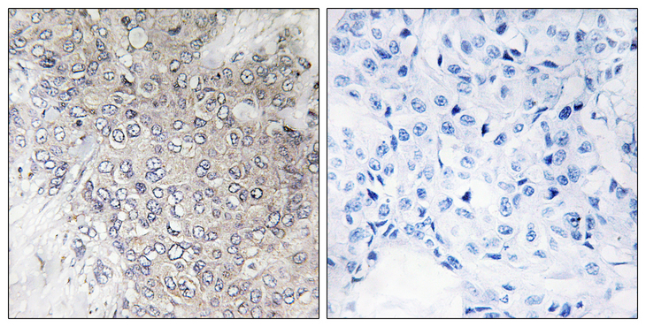 RPS6KB1 / P70S6K / S6K Antibody - Immunohistochemistry analysis of paraffin-embedded human breast carcinoma, using p70 S6 Kinase (Phospho-Thr421) Antibody. The picture on the right is blocked with the phospho peptide.