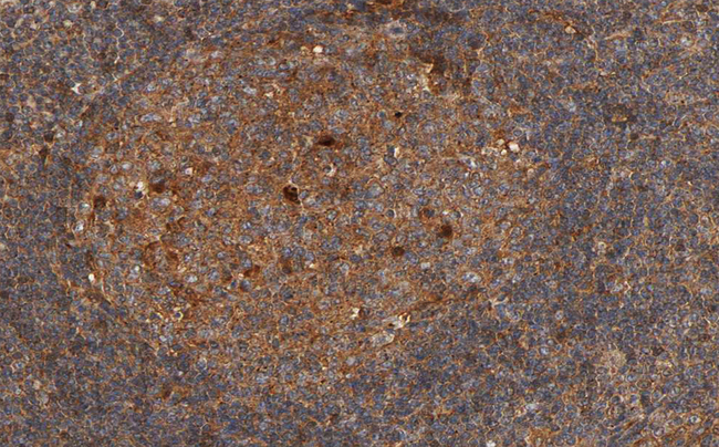 RPS6KB1 / P70S6K / S6K Antibody - 1:100 staining human lymphoma tissue by IHC-P. The tissue was formaldehyde fixed and a heat mediated antigen retrieval step in citrate buffer was performed. The tissue was then blocked and incubated with the antibody for 1.5 hours at 22°C. An HRP conjugated goat anti-rabbit antibody was used as the secondary.