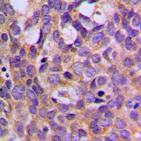 RPS6KB1 / P70S6K / S6K Antibody - Immunohistochemical analysis of S6K1 (pT444) staining in human breast cancer formalin fixed paraffin embedded tissue section. The section was pre-treated using heat mediated antigen retrieval with sodium citrate buffer (pH 6.0). The section was then incubated with the antibody at room temperature and detected using an HRP conjugated compact polymer system. DAB was used as the chromogen. The section was then counterstained with hematoxylin and mounted with DPX.