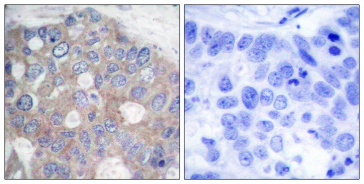 RPS6KB1 / P70S6K / S6K Antibody - Immunohistochemistry of paraffin-embedded human breast carcinoma tissue using p70 S6 Kinase(Ab-421) antibody (left) or the same antibody preincubated with blocking peptide (right).