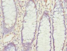 RPS6KL1 Antibody - Immunohistochemistry of paraffin-embedded human colon cancer at dilution 1:100