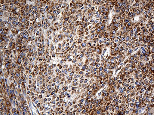 RPSA / Laminin Receptor Antibody - Immunohistochemical staining of paraffin-embedded Carcinoma of Human liver tissue using anti-RPSA mouse monoclonal antibody. (Heat-induced epitope retrieval by 1mM EDTA in 10mM Tris buffer. (pH8.5) at 120°C for 3 min. (1:2000)