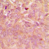 RPSA / Laminin Receptor Antibody - Immunohistochemical analysis of Laminin Receptor staining in human breast cancer formalin fixed paraffin embedded tissue section. The section was pre-treated using heat mediated antigen retrieval with sodium citrate buffer (pH 6.0). The section was then incubated with the antibody at room temperature and detected using an HRP polymer system. DAB was used as the chromogen. The section was then counterstained with hematoxylin and mounted with DPX.