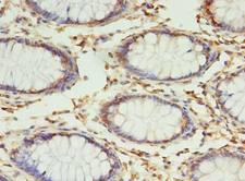 RPUSD4 Antibody - Immunohistochemistry of paraffin-embedded human colon cancer using antibody at dilution of 1:100.