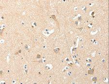 RRAD Antibody - Immunohistochemistry of paraffin-embedded Human colon cancer using RRAD Polyclonal Antibody at dilution of 1:50.