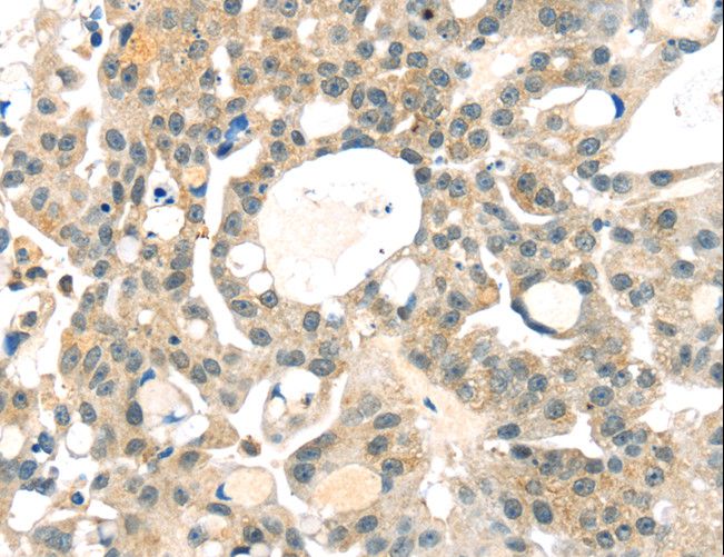 RRAGA Antibody - Immunohistochemistry of paraffin-embedded Human breast cancer using RRAGA Polyclonal Antibody at dilution of 1:25.