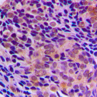 RRAGA+B Antibody - Immunohistochemical analysis of RagA/B staining in human prostate cancer formalin fixed paraffin embedded tissue section. The section was pre-treated using heat mediated antigen retrieval with sodium citrate buffer (pH 6.0). The section was then incubated with the antibody at room temperature and detected using an HRP conjugated compact polymer system. DAB was used as the chromogen. The section was then counterstained with hematoxylin and mounted with DPX.