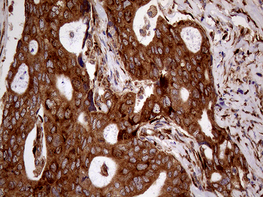 RRBP1 / hES Antibody - Immunohistochemical staining of paraffin-embedded Adenocarcinoma of Human breast tissue tissue using anti-RRBP1 mouse monoclonal antibody. (Heat-induced epitope retrieval by 1mM EDTA in 10mM Tris buffer. (pH8.5) at 120°C for 3 min. (1:1000)