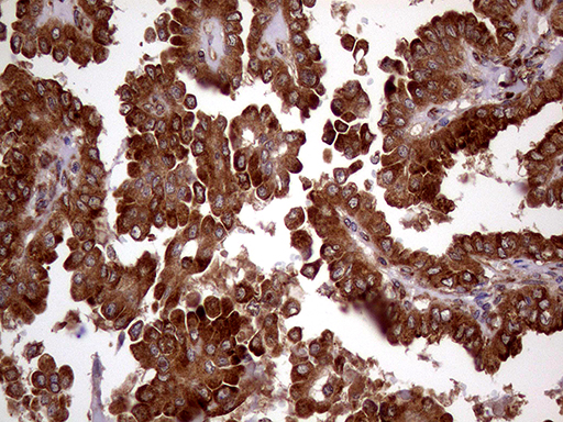 RRBP1 / hES Antibody - Immunohistochemical staining of paraffin-embedded Carcinoma of Human thyroid tissue using anti-RRBP1 mouse monoclonal antibody. (Heat-induced epitope retrieval by 1mM EDTA in 10mM Tris buffer. (pH8.5) at 120°C for 3 min. (1:1000)