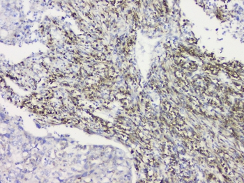 RRBP1 / hES Antibody - IHC staining of FFPE human lung cancer with RRBP1 antibody at 1ug/ml. HIER: boil tissue sections in pH6, 10mM citrate buffer, for 10-20 min and allow to cool before testing.