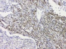 RRBP1 / hES Antibody - IHC staining of FFPE human lung cancer with RRBP1 antibody at 1ug/ml. HIER: boil tissue sections in pH6, 10mM citrate buffer, for 10-20 min and allow to cool before testing.