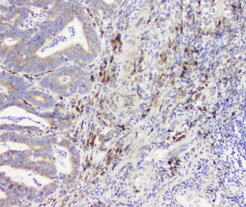 RRBP1 / hES Antibody - IHC staining of FFPE human intestinal cancer with RRBP1 antibody at 1ug/ml. HIER: boil tissue sections in pH6, 10mM citrate buffer, for 10-20 min and allow to cool before testing.