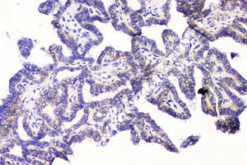 RRBP1 / hES Antibody - IHC staining of FFPE human thyroid cancer with RRBP1 antibody at 1ug/ml. HIER: boil tissue sections in pH6, 10mM citrate buffer, for 10-20 min and allow to cool before testing.