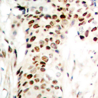 RREB1 Antibody - Immunohistochemical analysis of Zep-1 staining in human breast cancer formalin fixed paraffin embedded tissue section. The section was pre-treated using heat mediated antigen retrieval with sodium citrate buffer (pH 6.0). The section was then incubated with the antibody at room temperature and detected using an HRP conjugated compact polymer system. DAB was used as the chromogen. The section was then counterstained with hematoxylin and mounted with DPX.